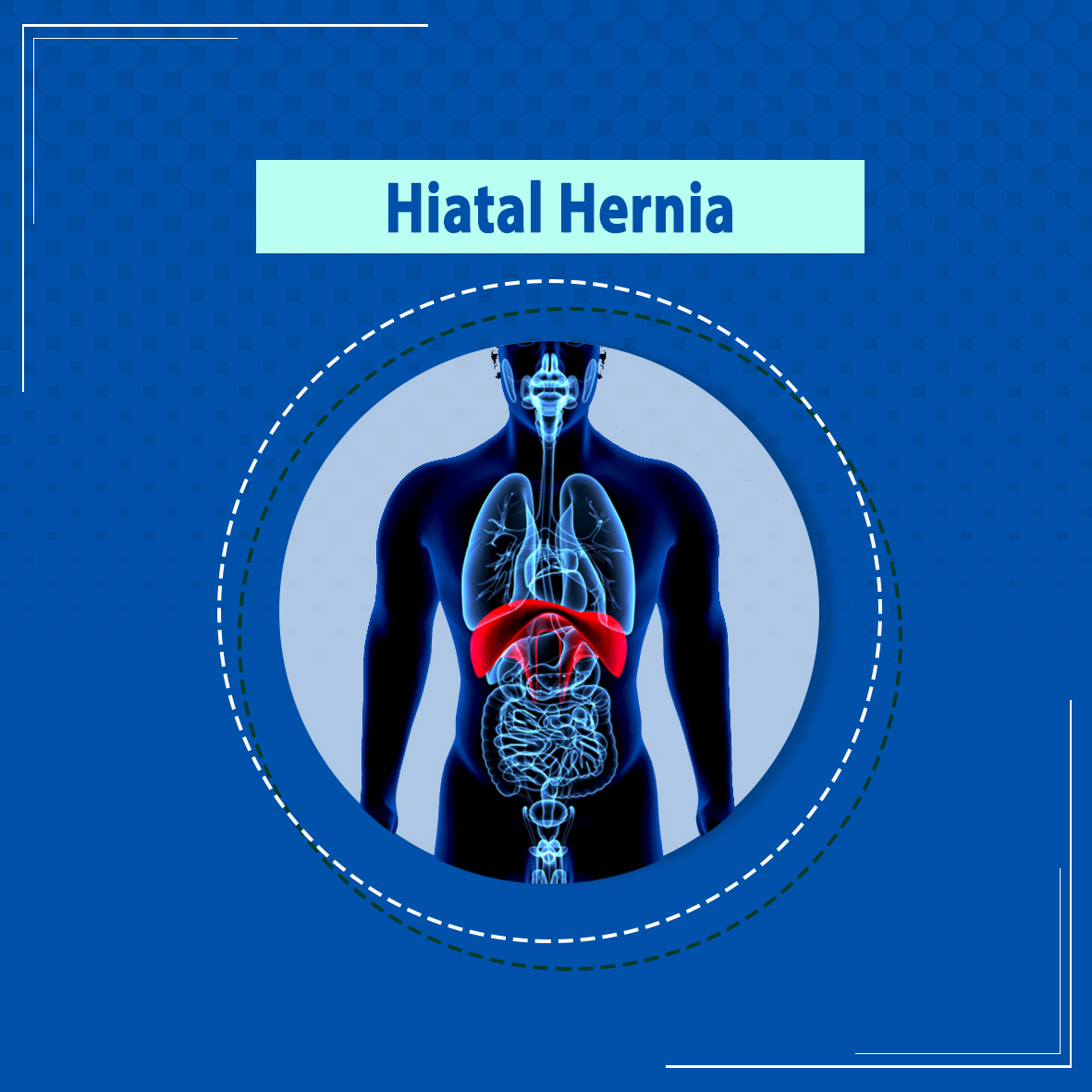 Hiatal Hernia