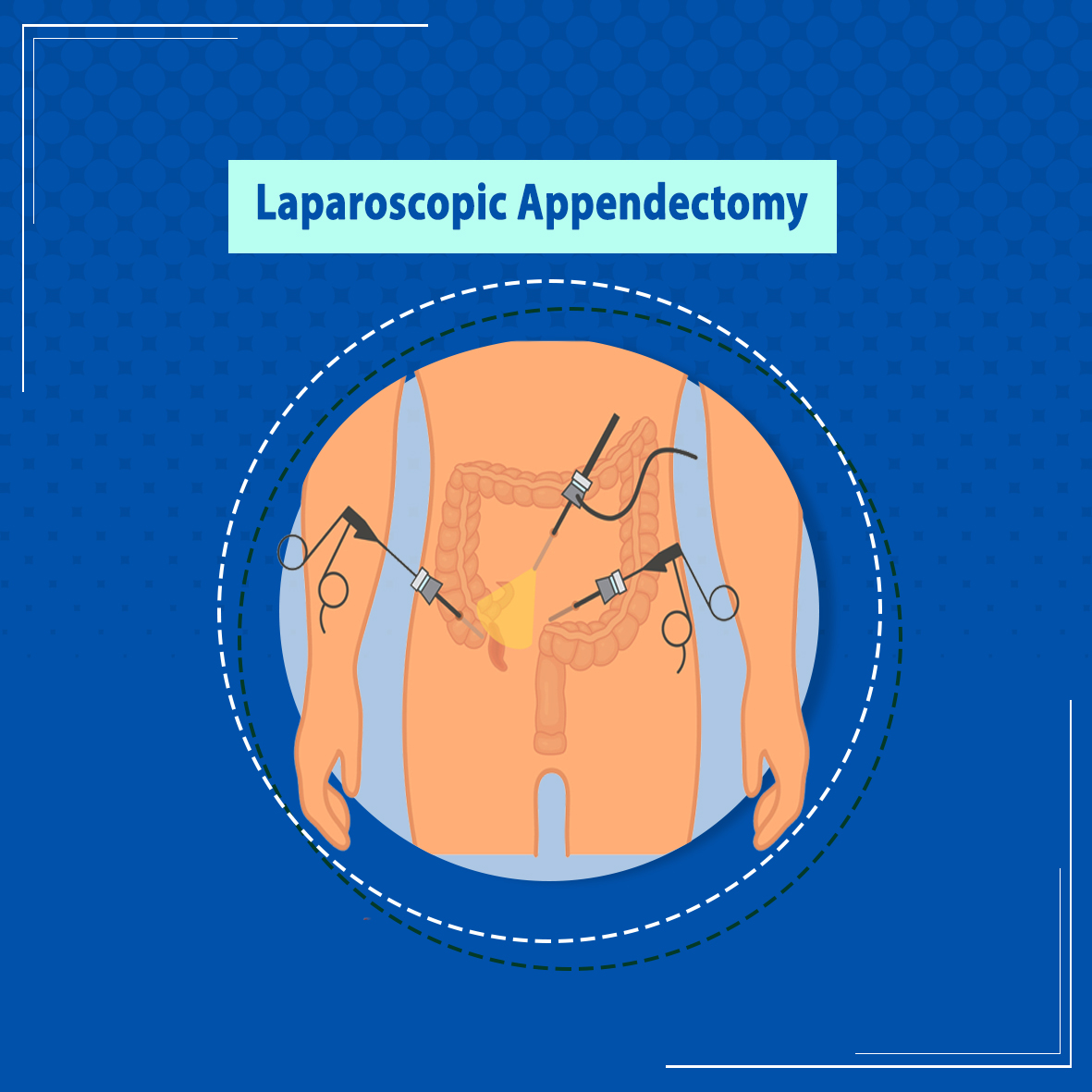 Laparoscopic appendectomy