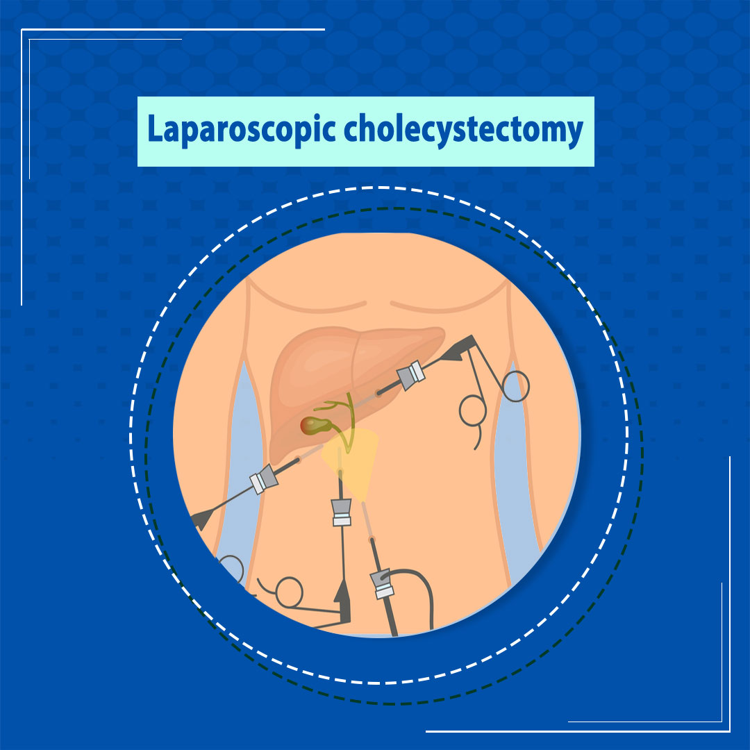 Laparoscopic cholecystectomy