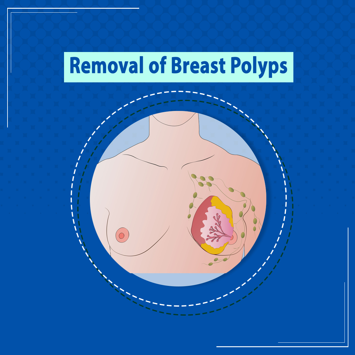 Removal of breast polyps