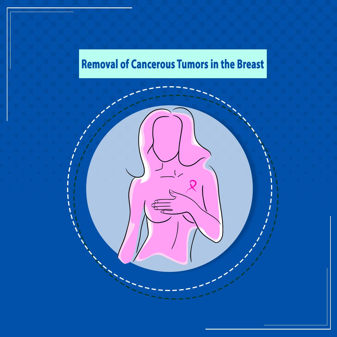 Removal of cancerous tumors in the breast