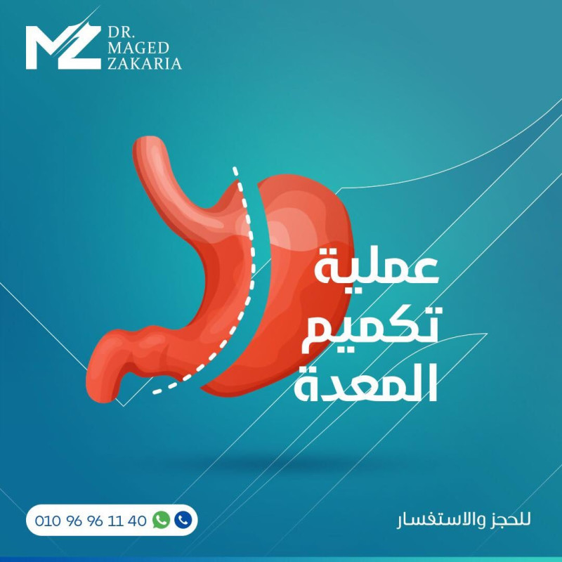  تكميم المعدة بالمنظار 