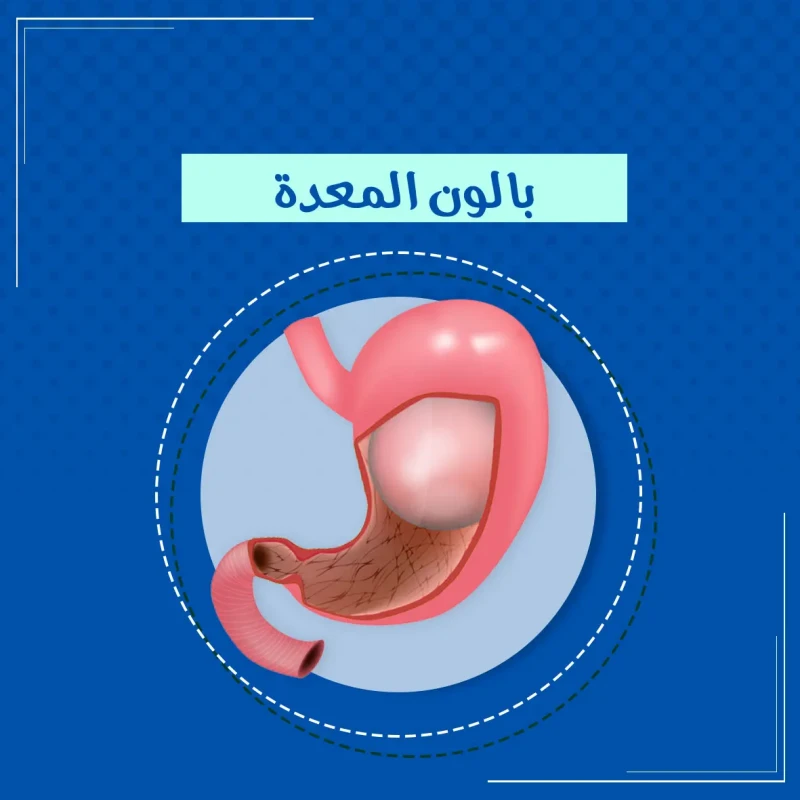  تكميم المعدة بالمنظار 