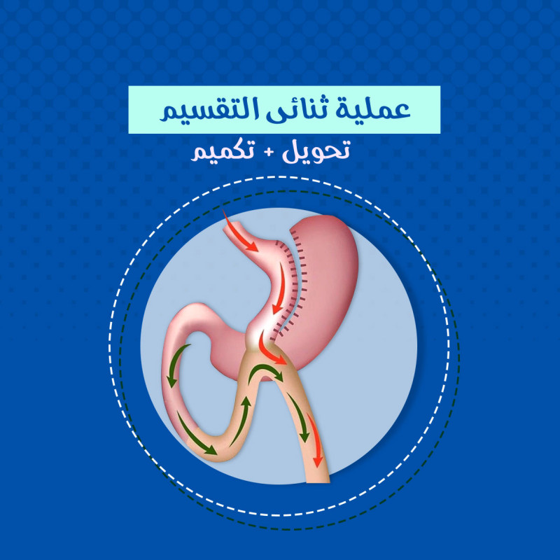  تكميم المعدة بالمنظار 