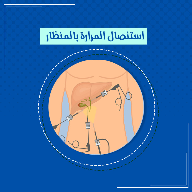  تكميم المعدة بالمنظار 