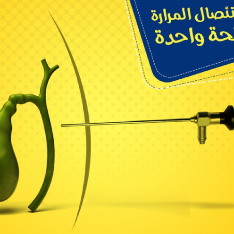  تكميم المعدة بالمنظار 