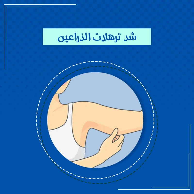  تكميم المعدة بالمنظار 