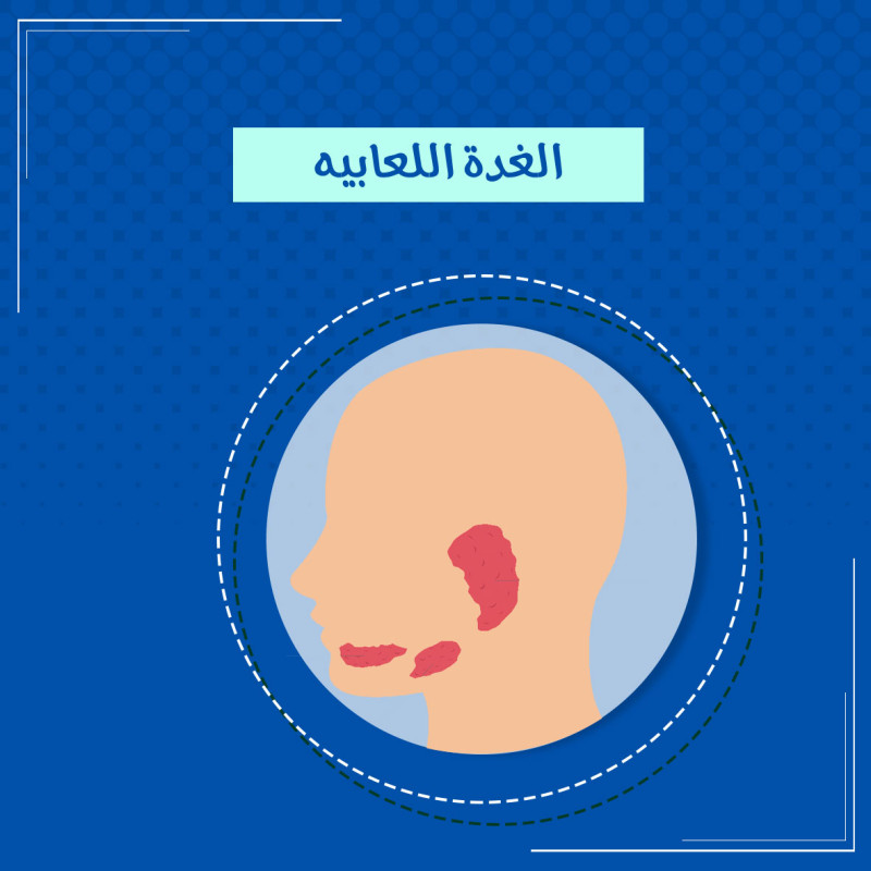  تكميم المعدة بالمنظار 