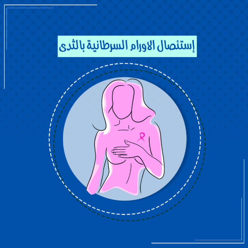  تكميم المعدة بالمنظار 