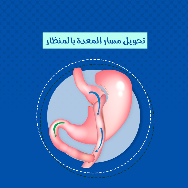  تكميم المعدة بالمنظار 