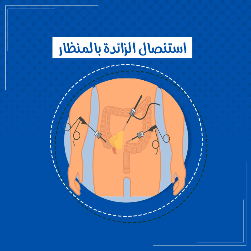  تكميم المعدة بالمنظار 