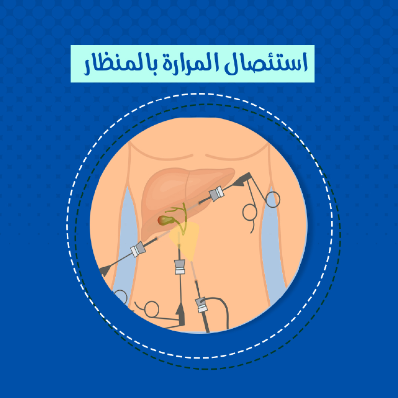  تكميم المعدة بالمنظار 